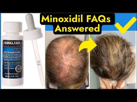 Minoxidil FAQs : r/minoxidil .